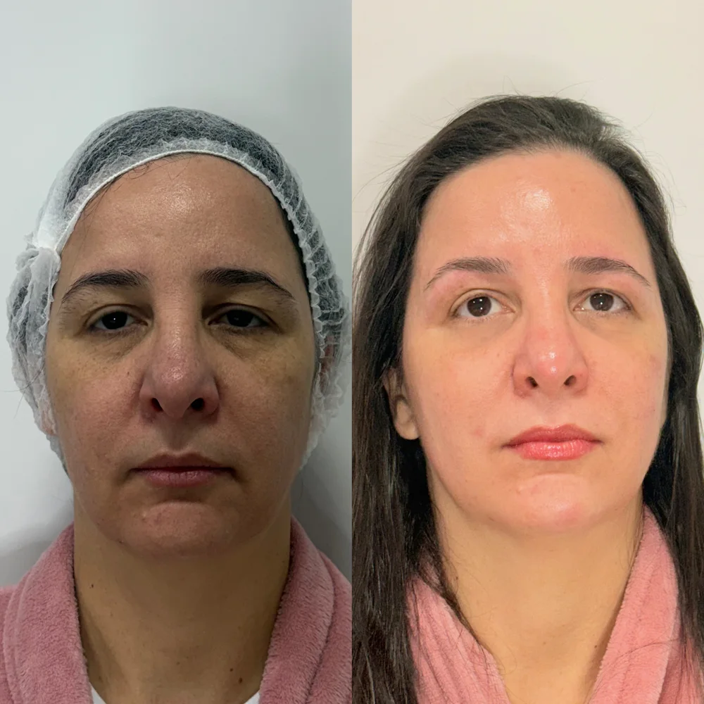 Resultado de limpeza de pele