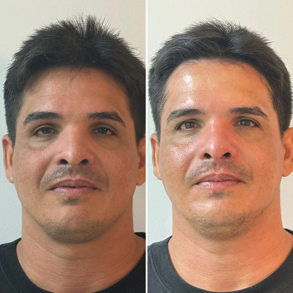 Resultado de limpeza de pele masculina